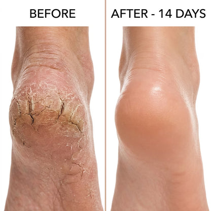 Healing Therapy Gel Socks✨ | Buy One Get One Free 🔥| Adjustable Size